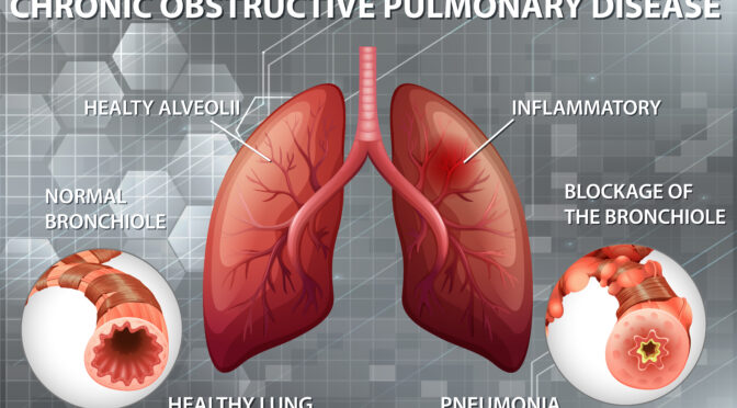 Understanding Chronic Obstructive Pulmonary Disease (COPD)