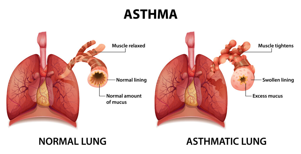 Asthma- Common Lung Diseases in Kerala