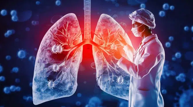 Comprehensive Guide to Common Lung Diseases in Kerala